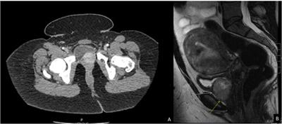 Case report: A novel somatic SDHB variant in a patient with bladder paraganglioma